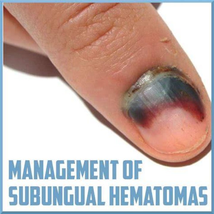 Does draining a subungual hematoma hurt?