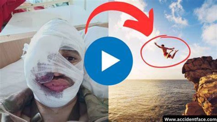 FACE SPLIT DIVING ACCIDENT BOY FACE SPLIT WHILE DIVING
