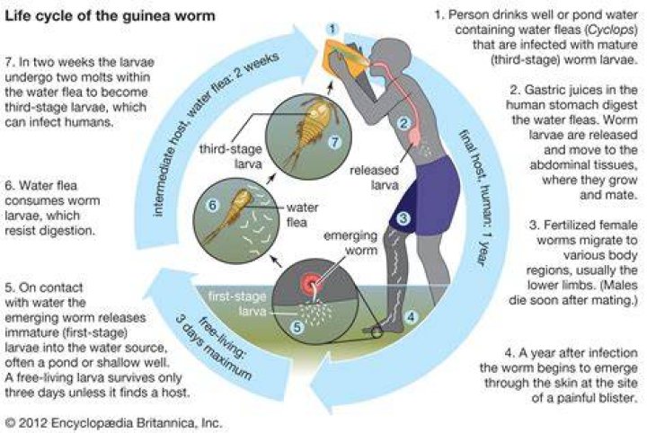How is a Guinea worm removed?