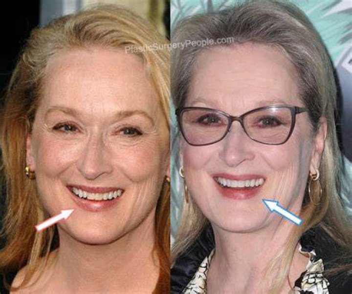 meryl streep plastic surgery