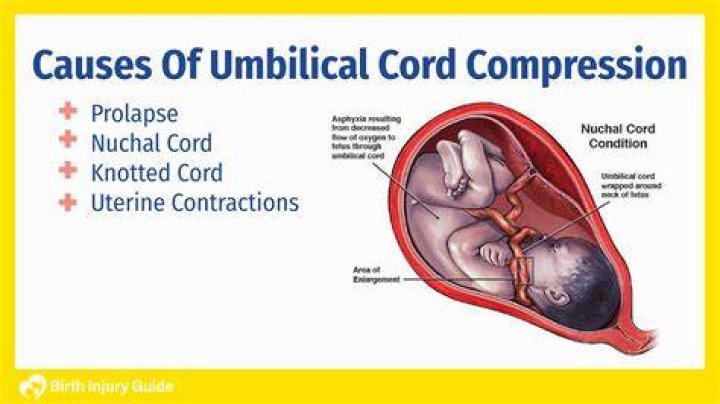 What causes cord avulsion?