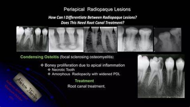 What Causes Peri-apical Radiolucency In Implants? (Correct answer)