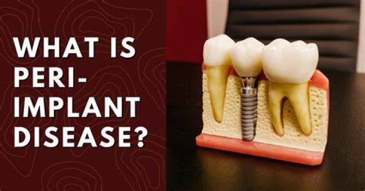 What Is Peri-implant? (Best solution)