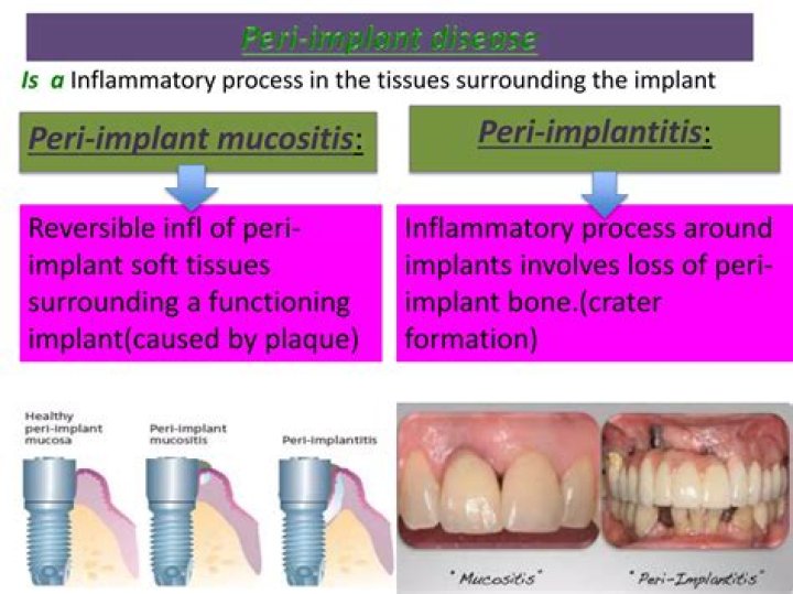 What Is Peri Implant Bone? (Solved)