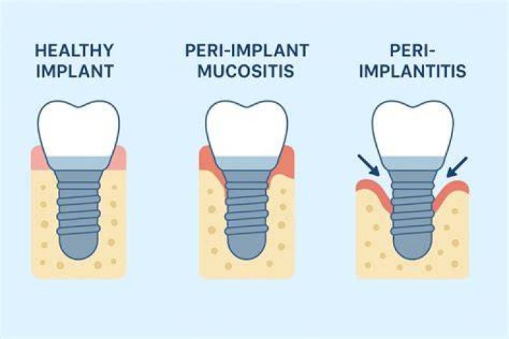What Is Peri Implant Disease? (Solution found)