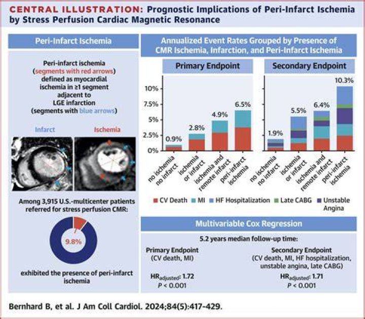 What Is Peri Infarct Ischemia? (Solution found)