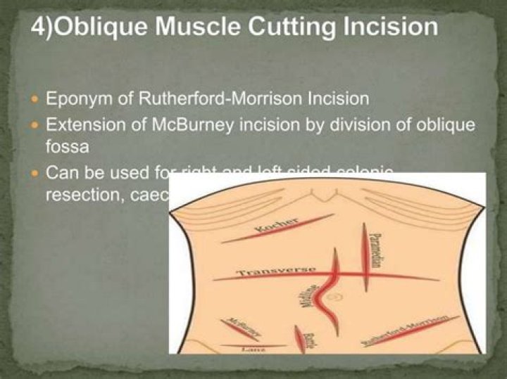 What is Rutherford Morison incision?